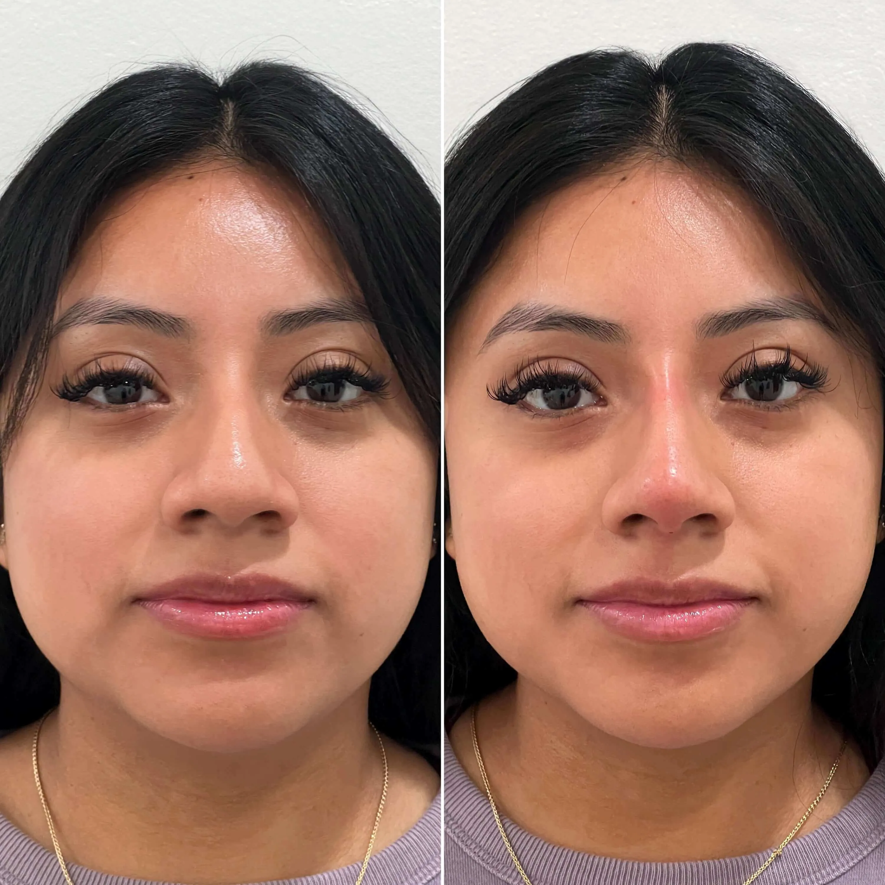 NoseFix: Slimming