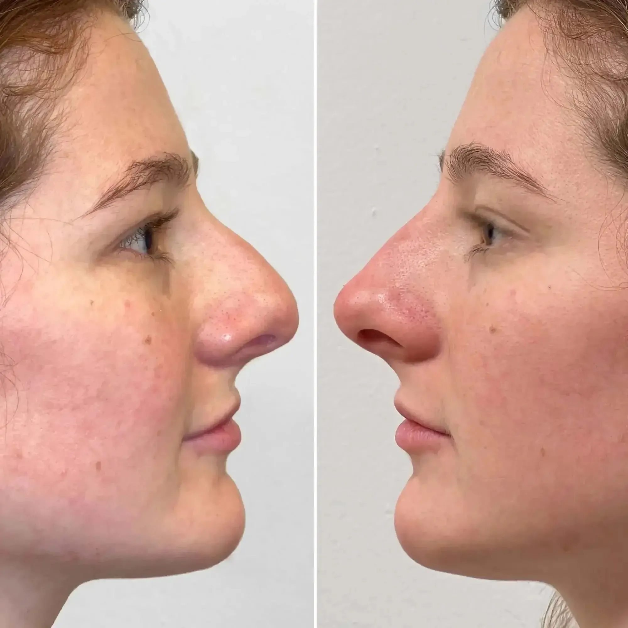 NoseFix: Slimming