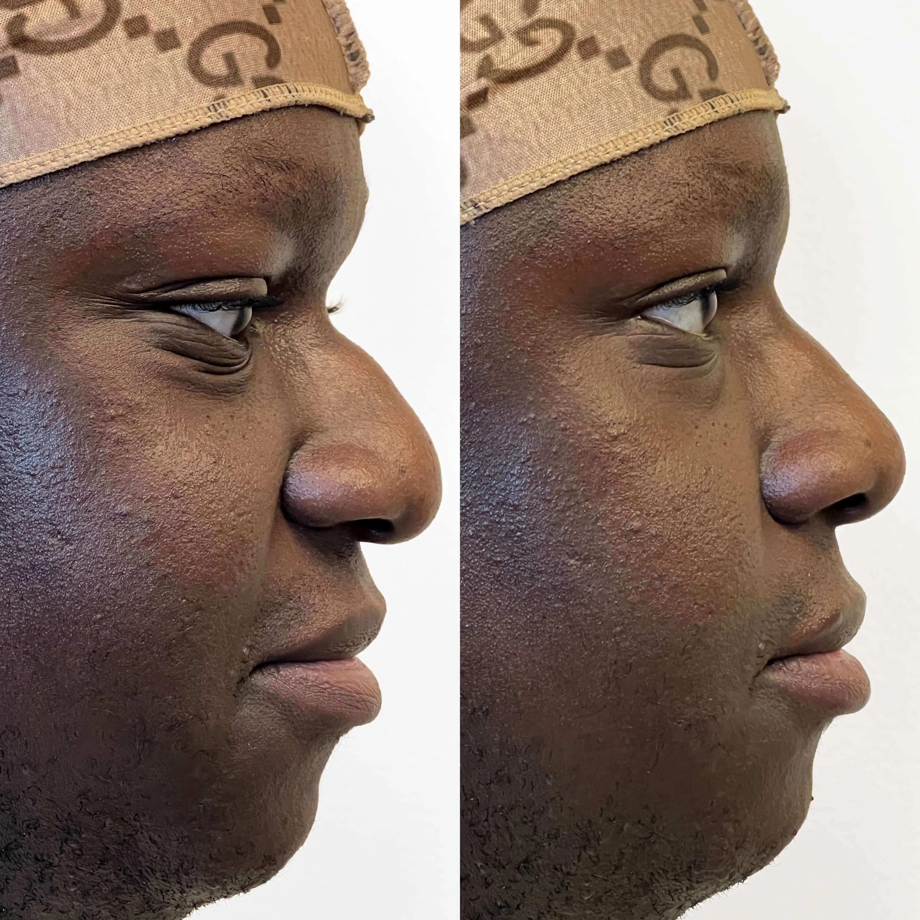 NoseFix: Slimming