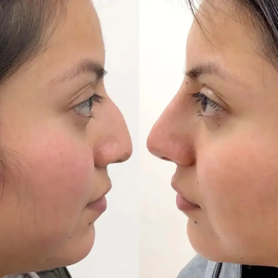 NoseFix: Slimming