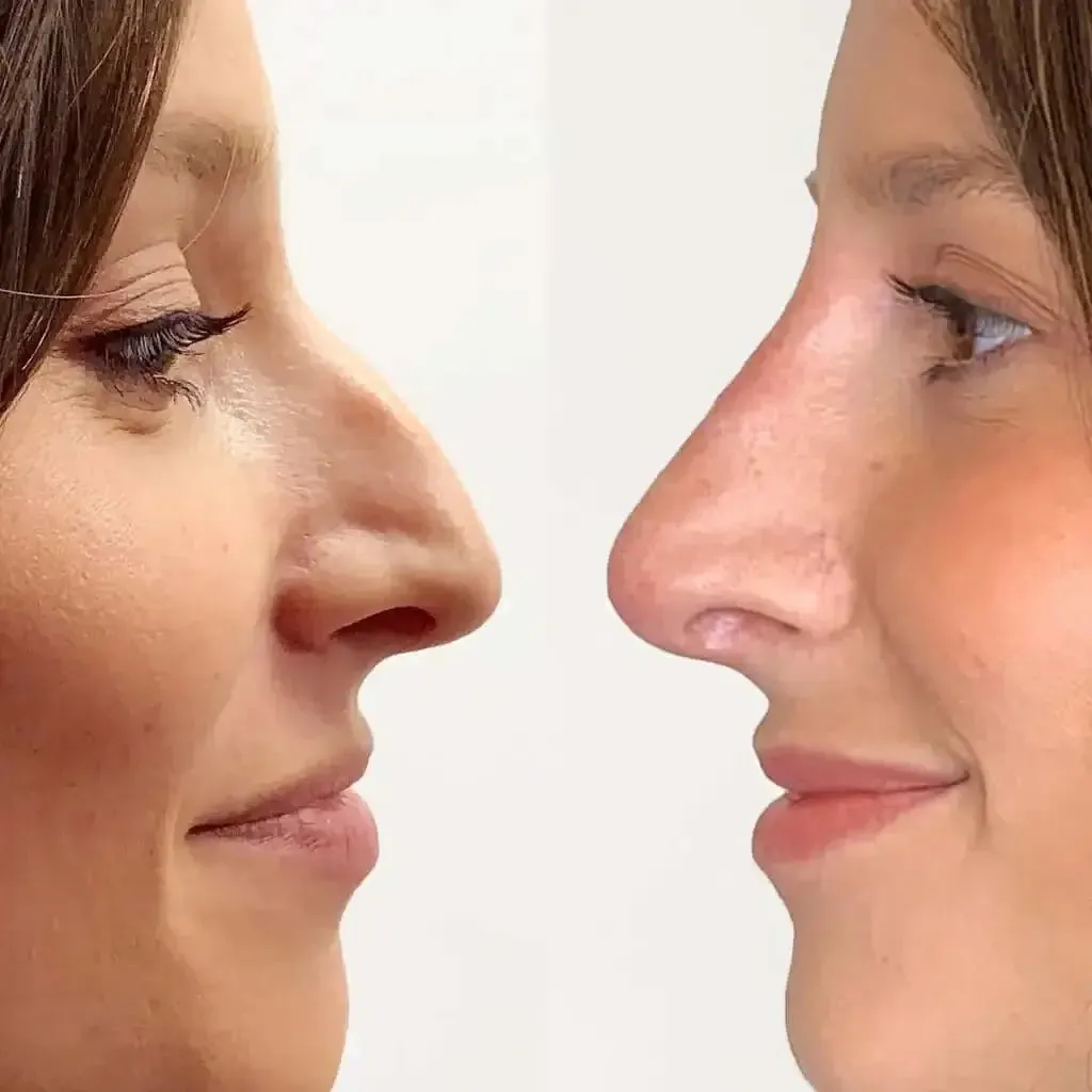 NoseFix: Slimming