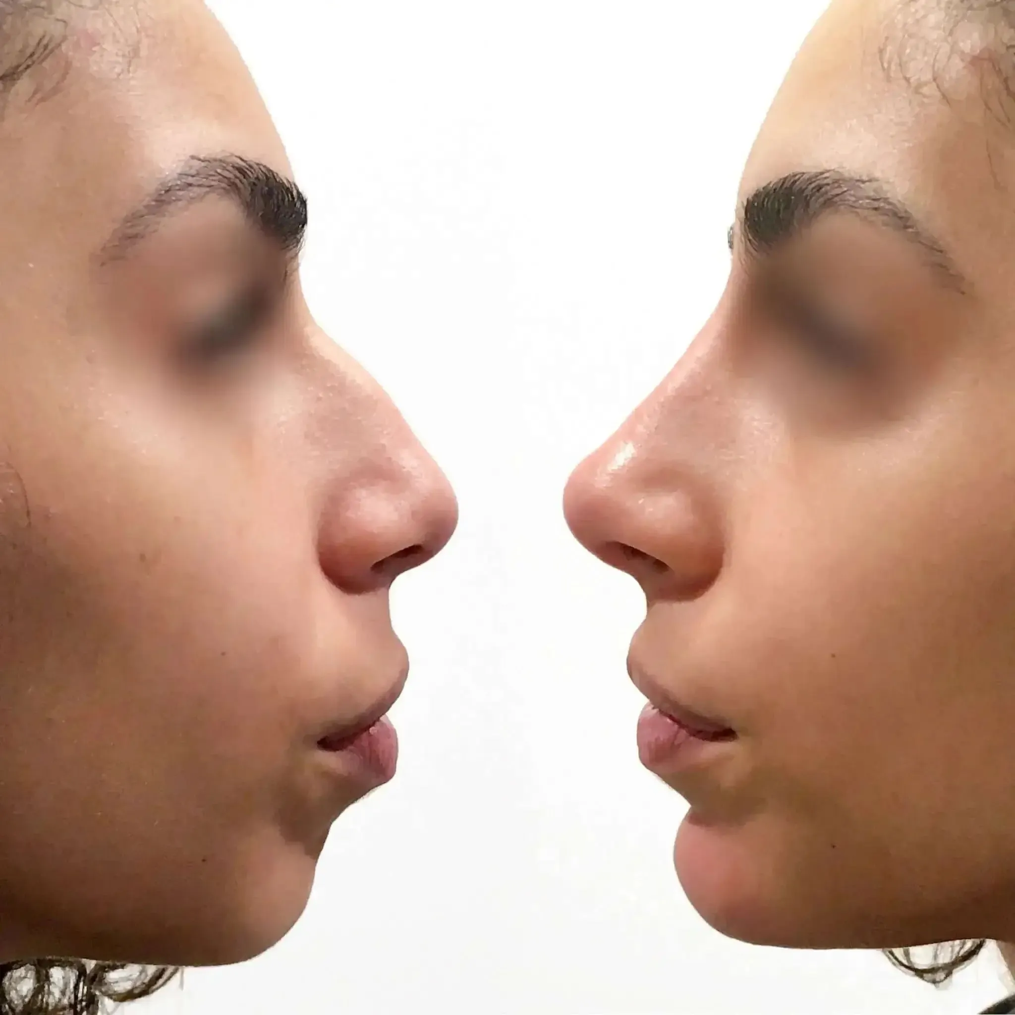 NoseFix: Slimming