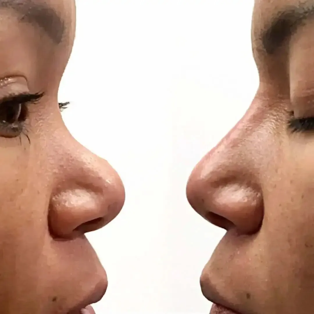 NoseFix: Slimming