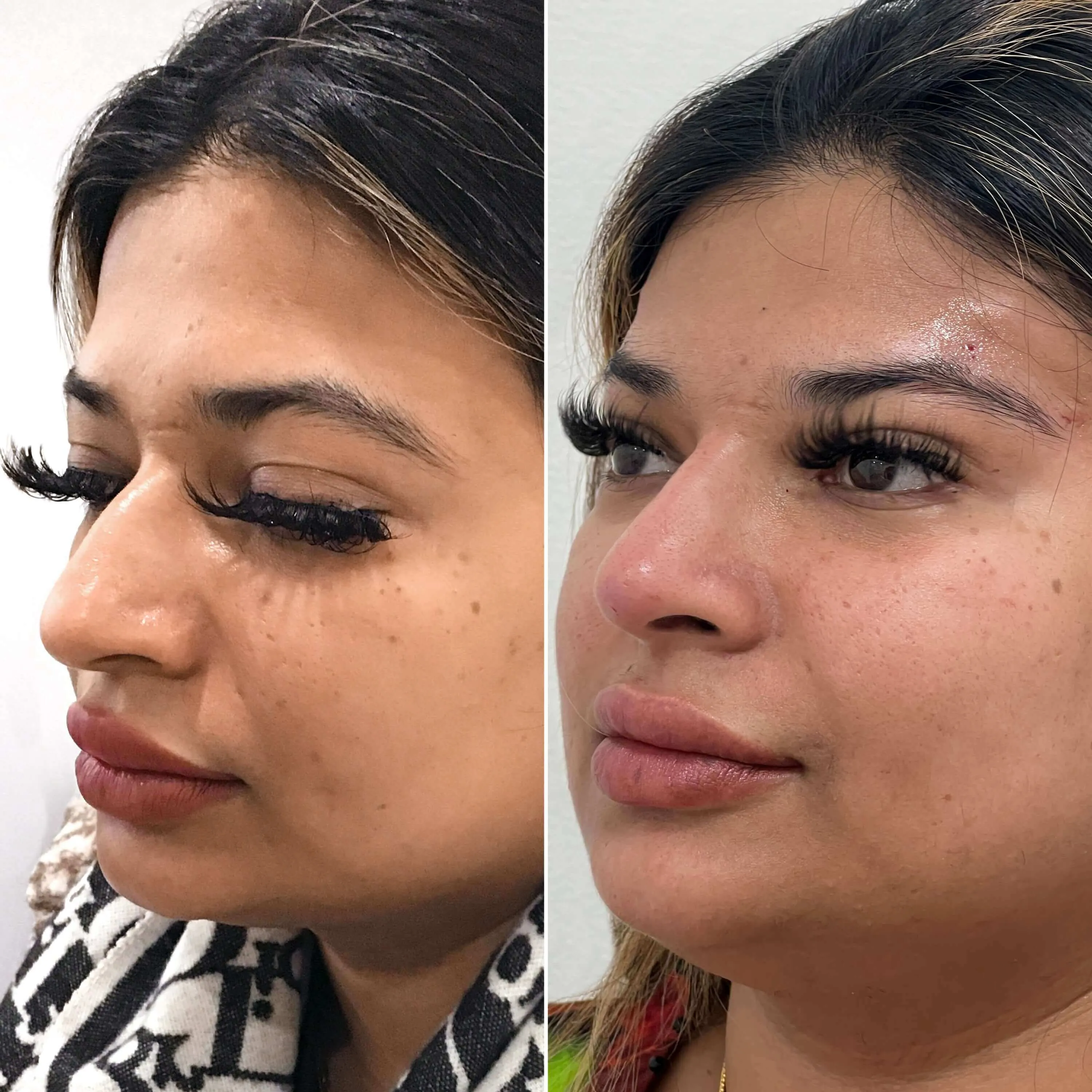 NoseFix: Slimming