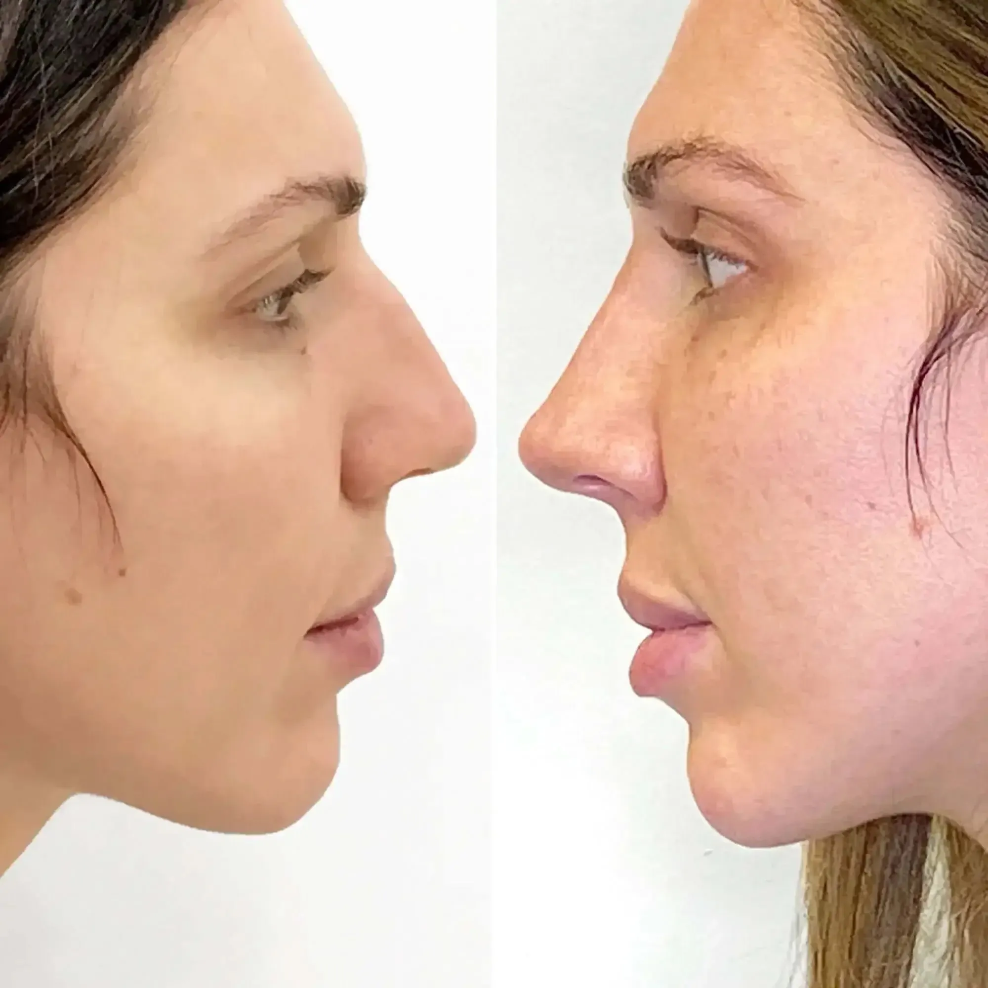 NoseFix: Slimming