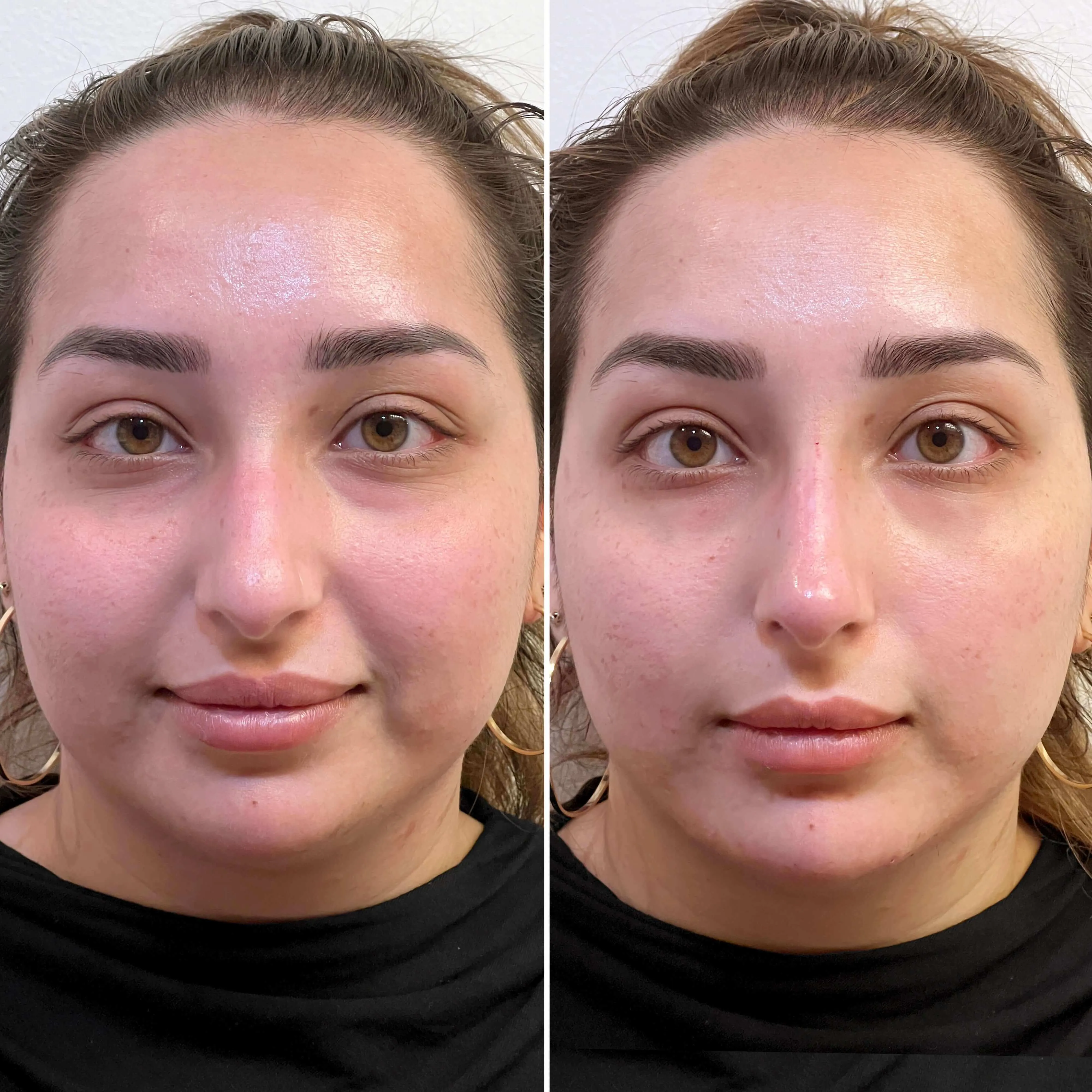 NoseFix: Slimming