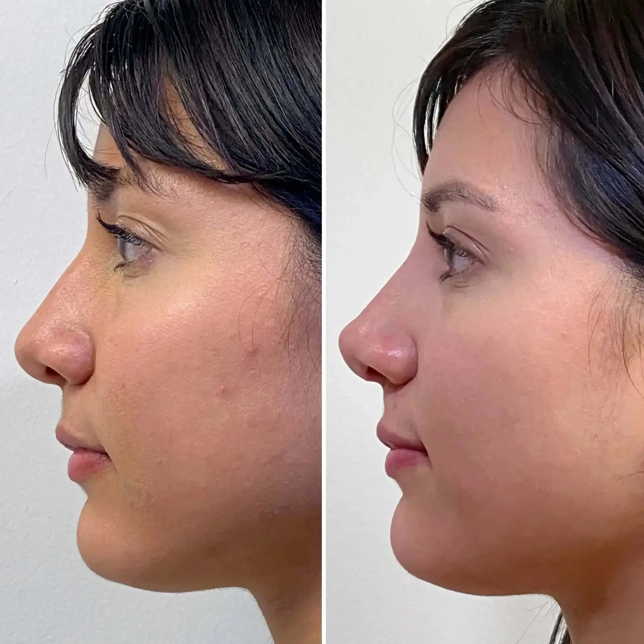 NoseFix: Slimming